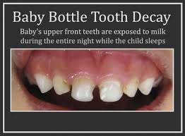 Baby bottle tooth decay prevention — pediatric dentistry blog article image