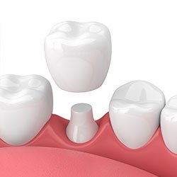 Same-day CEREC dental crown in Elk Grove