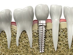 Dental implant replacement in Elk Grove