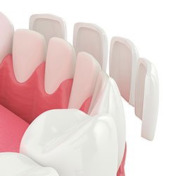 Porcelain veneers and cosmetic restorations in Elk Grove